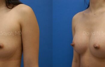 Breast Augmentation Before and After | Sayah Institute