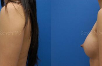 Breast Augmentation Before and After | Sayah Institute