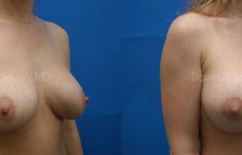 Breast Implant Revision Before and After | Sayah Institute