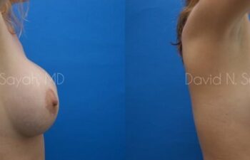 Breast Implant Revision Before and After | Sayah Institute