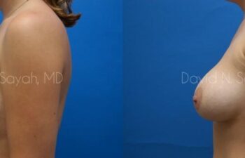 Breast Implant Revision Before and After | Sayah Institute