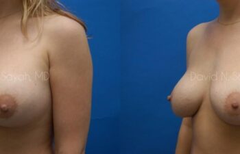 Breast Implant Revision Before and After | Sayah Institute