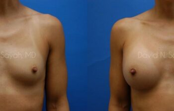 Breast Augmentation Before and After | Sayah Institute