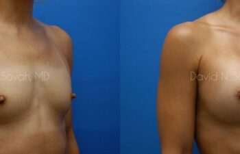 Breast Augmentation Before and After | Sayah Institute