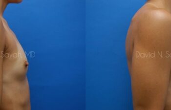 Breast Augmentation Before and After | Sayah Institute