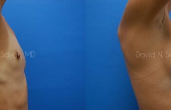 Breast Augmentation Before and After | Sayah Institute