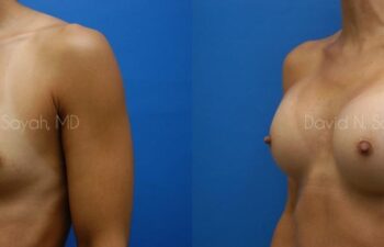 Breast Augmentation Before and After | Sayah Institute