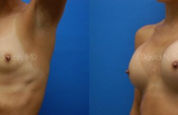 Breast Augmentation Before and After | Sayah Institute