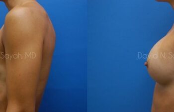 Breast Augmentation Before and After | Sayah Institute