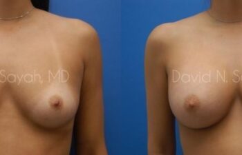 Breast Augmentation Before and After | Sayah Institute