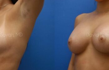 Breast Augmentation Before and After | Sayah Institute