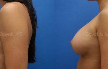 Breast Augmentation Before and After | Sayah Institute