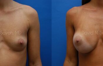 Breast Augmentation Before and After | Sayah Institute