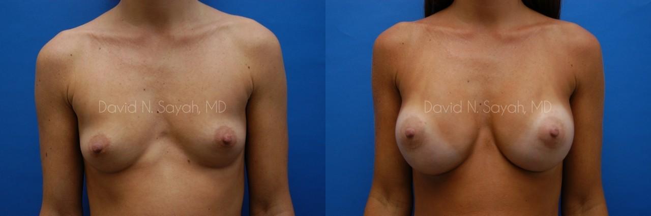 Breast Augmentation Before and After | Sayah Institute