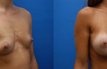 Breast Augmentation Before and After | Sayah Institute