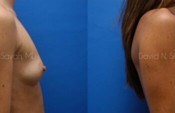 Breast Augmentation Before and After | Sayah Institute