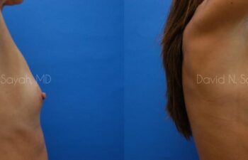 Breast Augmentation Before and After | Sayah Institute