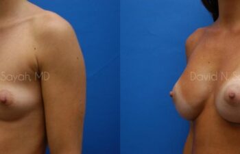 Breast Augmentation Before and After | Sayah Institute