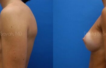Breast Augmentation Before and After | Sayah Institute