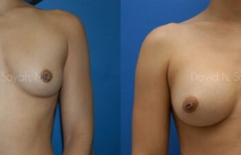 Breast Augmentation Before and After | Sayah Institute