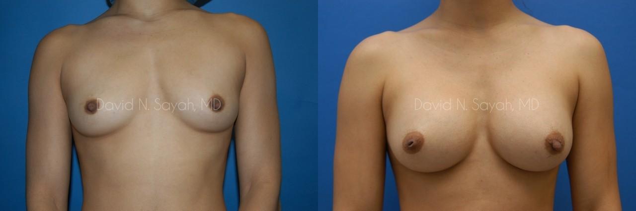 Breast Augmentation Before and After | Sayah Institute