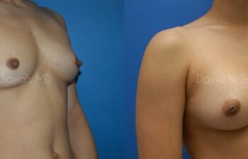 Breast Augmentation Before and After | Sayah Institute