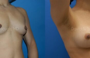 Breast Augmentation Before and After | Sayah Institute