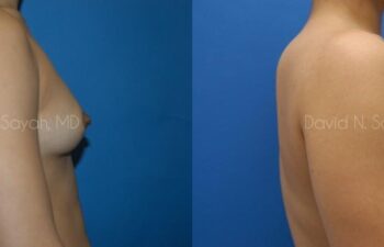 Breast Augmentation Before and After | Sayah Institute