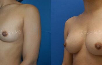 Breast Augmentation Before and After | Sayah Institute