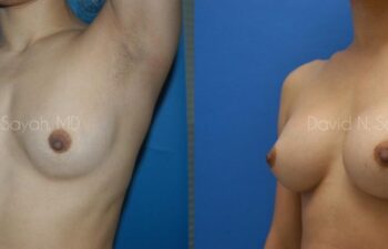Breast Augmentation Before and After | Sayah Institute