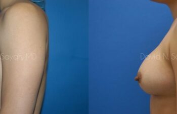 Breast Augmentation Before and After | Sayah Institute