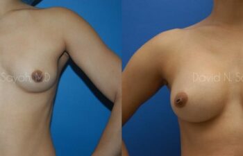 Breast Augmentation Before and After | Sayah Institute