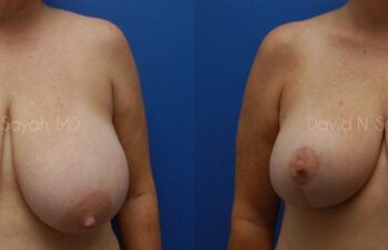 Mommy Makeover Before and After | Sayah Institute