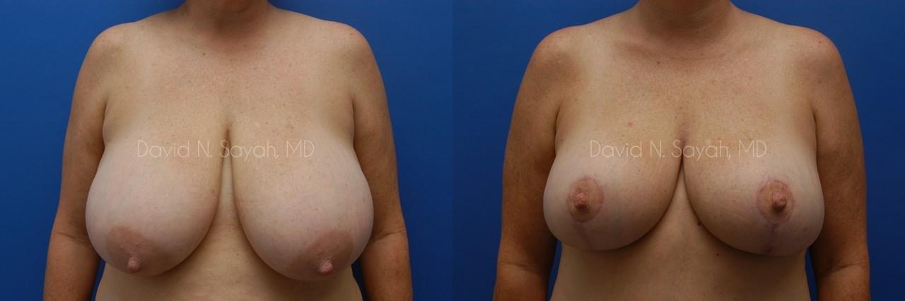 Mommy Makeover Before and After | Sayah Institute