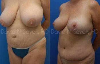 Mommy Makeover Before and After | Sayah Institute