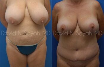 Mommy Makeover Before and After | Sayah Institute