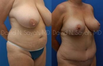 Mommy Makeover Before and After | Sayah Institute
