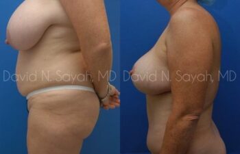 Mommy Makeover Before and After | Sayah Institute