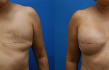 Breast Reconstruction Before and After | Sayah Institute