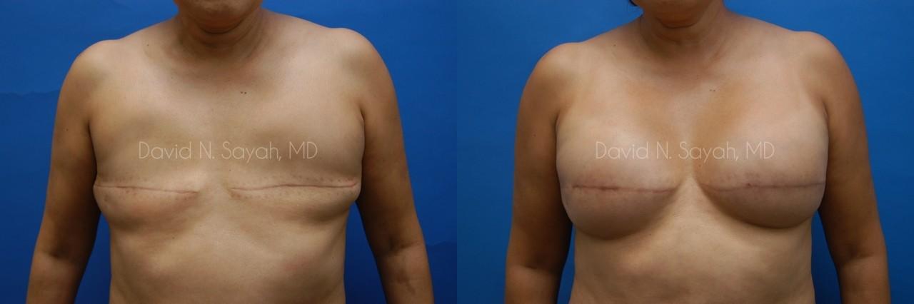 Breast Reconstruction Before and After | Sayah Institute