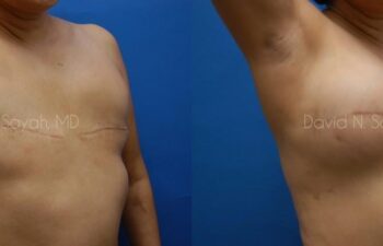 Breast Reconstruction Before and After | Sayah Institute