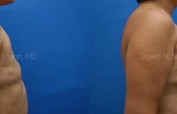 Breast Reconstruction Before and After | Sayah Institute