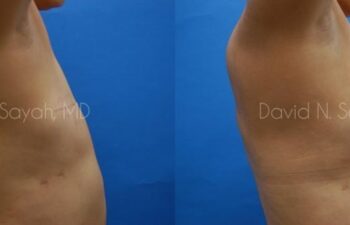 Breast Reconstruction Before and After | Sayah Institute