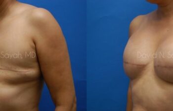 Breast Reconstruction Before and After | Sayah Institute