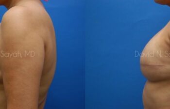 Breast Reconstruction Before and After | Sayah Institute