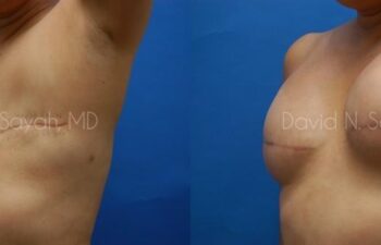 Breast Reconstruction Before and After | Sayah Institute