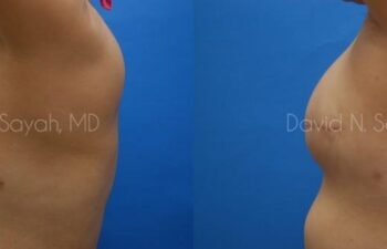 Breast Reconstruction Before and After | Sayah Institute