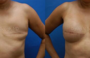 Breast Reconstruction Before and After | Sayah Institute