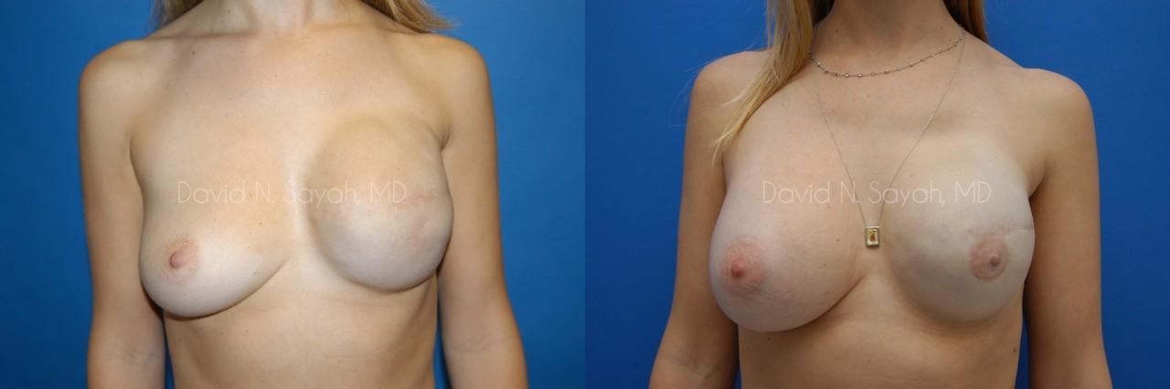 Breast Reconstruction Before and After | Sayah Institute