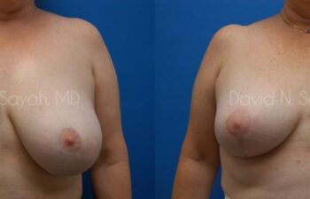 Breast Implant Revision Before and After | Sayah Institute